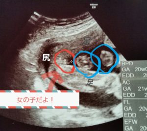 妊娠6ヶ月で性別判定出た～！エコー写真で見る女の子の図。 | 元にゃーごの育児生活